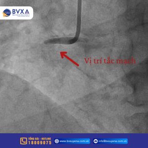 Hình ảnh vị trí đoạn mạch bị tắc