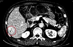 Hình ảnh CT khối u gan