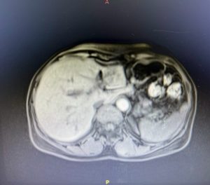 Hình ảnh CT vùng gan tổn thương