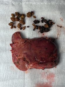 Phần gan bị cắt và sỏi trong gan
