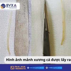 Hình ảnh dị vật xương cá