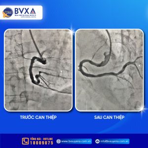 Hình ảnh kết quả trước và sau can thiệp