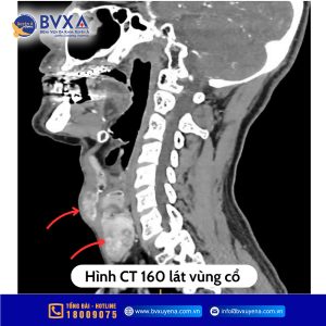 Hình ảnh chụp CT phát hiện bướu giáp
