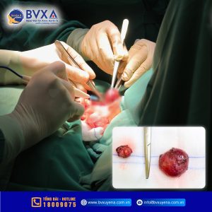 Hình ảnh khối bướu giáp được lấy ra