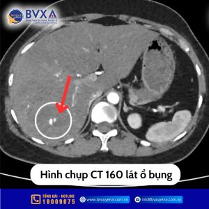 Hình ảnh chụp CT 160 lát ổ 3 bụng
