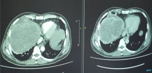 Hình ảnh CT trước điều trị cho bệnh nhân ung thư đại tràng di căn gan 15cm