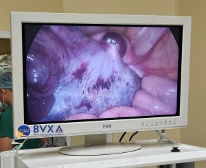 Hình ảnh u buồng xoắn qua màn hình nội soi