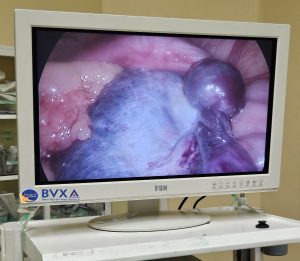 Hình ảnh u buồng xoắn qua màn hình nội soi, hoại tử tím đen