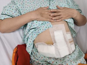 Hình ảnh vết thương sau mổ