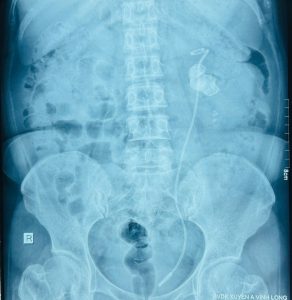 Hình ảnh trong quá trình tán sỏi bằng phương pháp MINI-PCNL