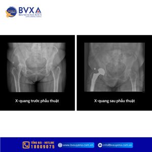 Hình ảnh X-Quang trước và sau phẫu thuật thay khớp háng