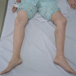 TẮC TĨNH MẠCH CHẬU – ĐÙI CẤP VÌ HUYẾT KHỐI, NGƯỜI PHỤ NỮ CÓ NGUY CƠ ĐOẠN CHI
