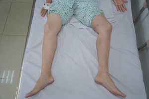 Hình ảnh bàn chân sau can thiệp một tuần của bệnh nhân bị tắc tĩnh mạch chậu - đùi