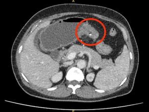 Hình ảnh CT khối u đại tràng trước mổ của bệnh nhân nội soi tiêu hóa đặt sonde qua u giải áp