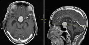 Hình ảnh MRI khối u tuyến yên 3cm của bn N.V.H