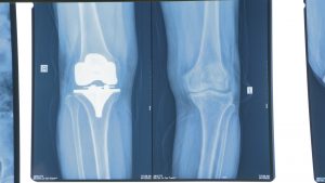 Hình ảnh khớp gối thoái hoá được thay khớp gối nhận tạo