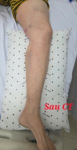 Hình ảnh chân hồng hào hết sưng sau can thiệp