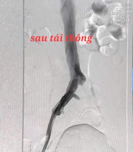 Hình ảnh sau can thiệp