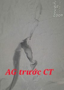 Hình ảnh trước can thiệp