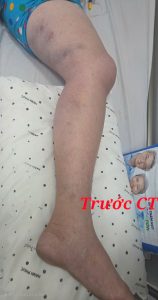 Hình ảnh chân sưng nề huyết khối tím tái trước can thiệp