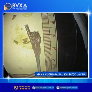 Hình ảnh mảnh xương gà gây thủng thực quảng sau khi được lấy ra