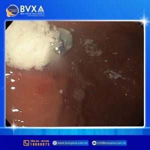 Hình ảnh dị vật trong cơ thể bé trai nuốt ốc vít