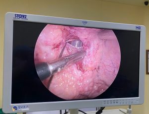 Màn hình nội soi phát hiện lỗ thủng do vỡ bàng quang tự phát - Bệnh Viện Đa Khoa Xuyên Á