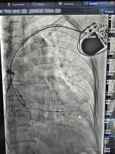 Hình ảnh máy tạo nhịp được cấy