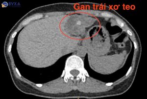 Hình ảnh CT phần gan bị xơ teo vì sỏi