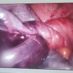 PHẪU THUẬT THÀNH CÔNG KHỐI U BUỒNG TRỨNG XOẮN KÍCH THƯỚC KHỦNG