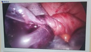 Hình ảnh khối u buồng trứng xoắn