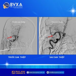 Hình ảnh mạch máu não của bệnh nhân đột quỵ trước và sau can thiệp