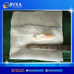 Hình ảnh nhân đĩa đệm được lấy ra