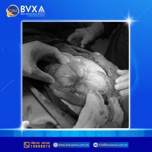 Hình ảnh quá trình mở ổ bụng của bệnh nhân vỡ động mạch mạc treo