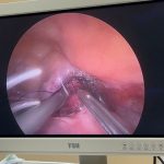 CHẤM DỨT SA SINH DỤC, LẤY LẠI TỰ TIN NHỜ PHẪU THUẬT NỘI SOI ĐẶT LƯỚI TẠI BVĐK XUYÊN Á VĨNH LONG