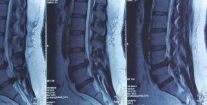 Hình ảnh MRI cho thấy tình trạng thoát vị đĩa đệm chèn ép nặng ống sống và rễ thần kinh