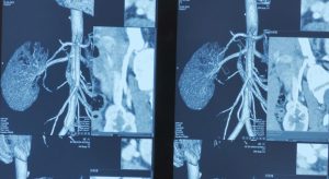 Hình ảnh MRI thận bệnh nhân suy thận mạn