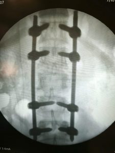 Hình ảnh trên phim sau phẫu thuật của bệnh nhân gãy cột sống