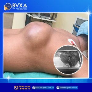 Hình ảnh khối u khổng lồ trên lưng bệnh nhân