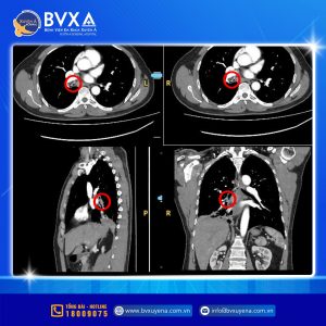 Hình ảnh CT lồng ngực xác định nguyên nhân của việc ho dai dẳng