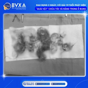 Hình ảnh khối u quái buồng trứng được lấy ra