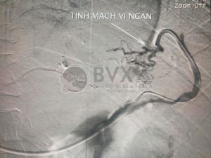 Hình ảnh cận lâm sàng của bệnh nhân vỡ giãn tĩnh mạch