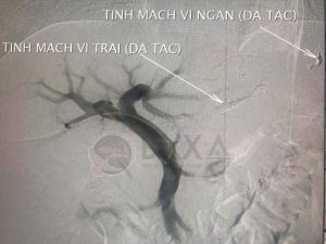 Hình ảnh cận lâm sàng của bệnh nhân vỡ giãn tĩnh mạch
