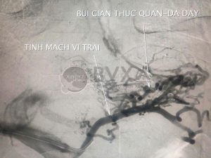 Hình ảnh cận lâm sàng của bệnh nhân vỡ giãn tĩnh mạch