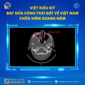 Hình ảnh CT của bệnh nhân viêm xoang nấm