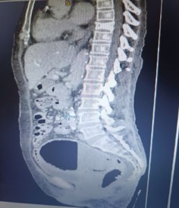 Hình ảnh CT khối áp xe tử cung