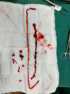 Hình ảnh đoạn tĩnh mạch giãn được phẫu thuật lấy ra