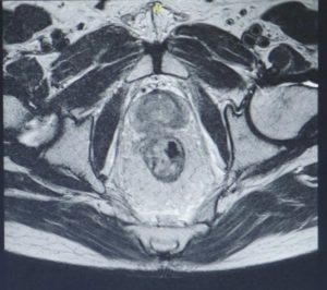 Hình ảnh CT sau xạ trị khối ung thư trực tràng được thu nhỏ