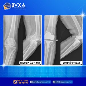 Hình ảnh X-Quang trước và sau phẫu thuật thoái hoá khớp gối