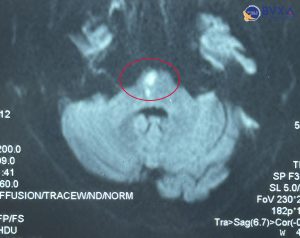 Hình ảnh cận lâm sàng cho thấy vị trí có huyết khối